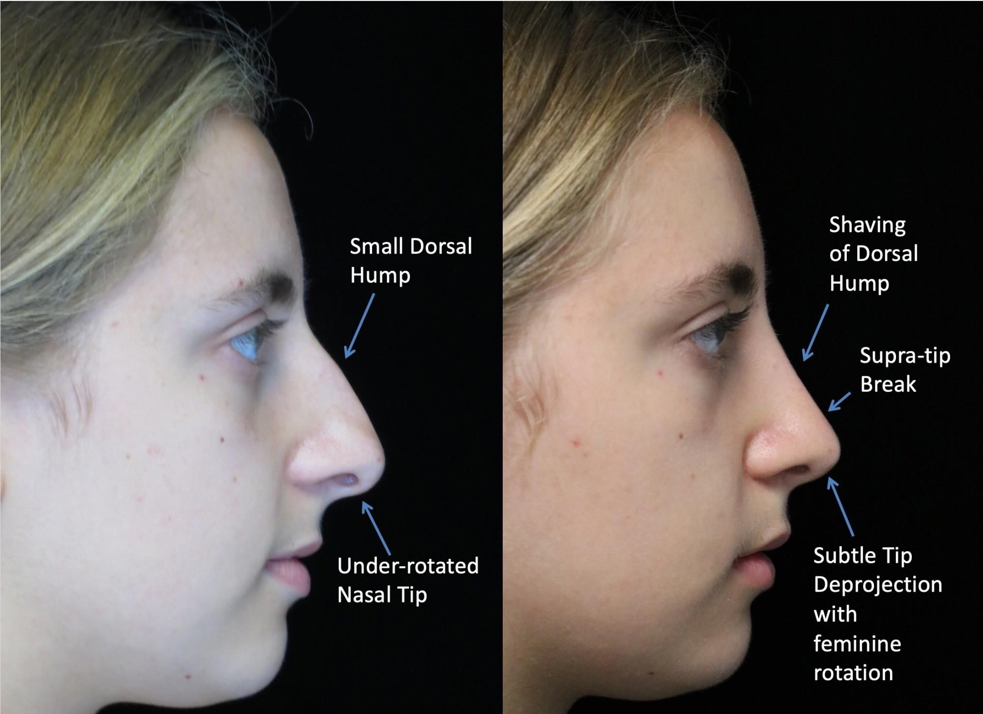 open vs closed rhinoplasty