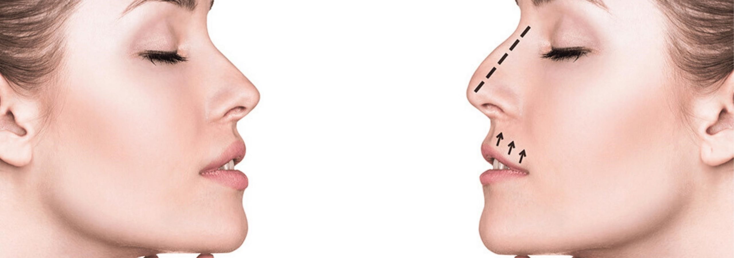 how much is rhinoplasty surgery