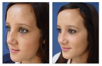 open vs closed rhinoplasty