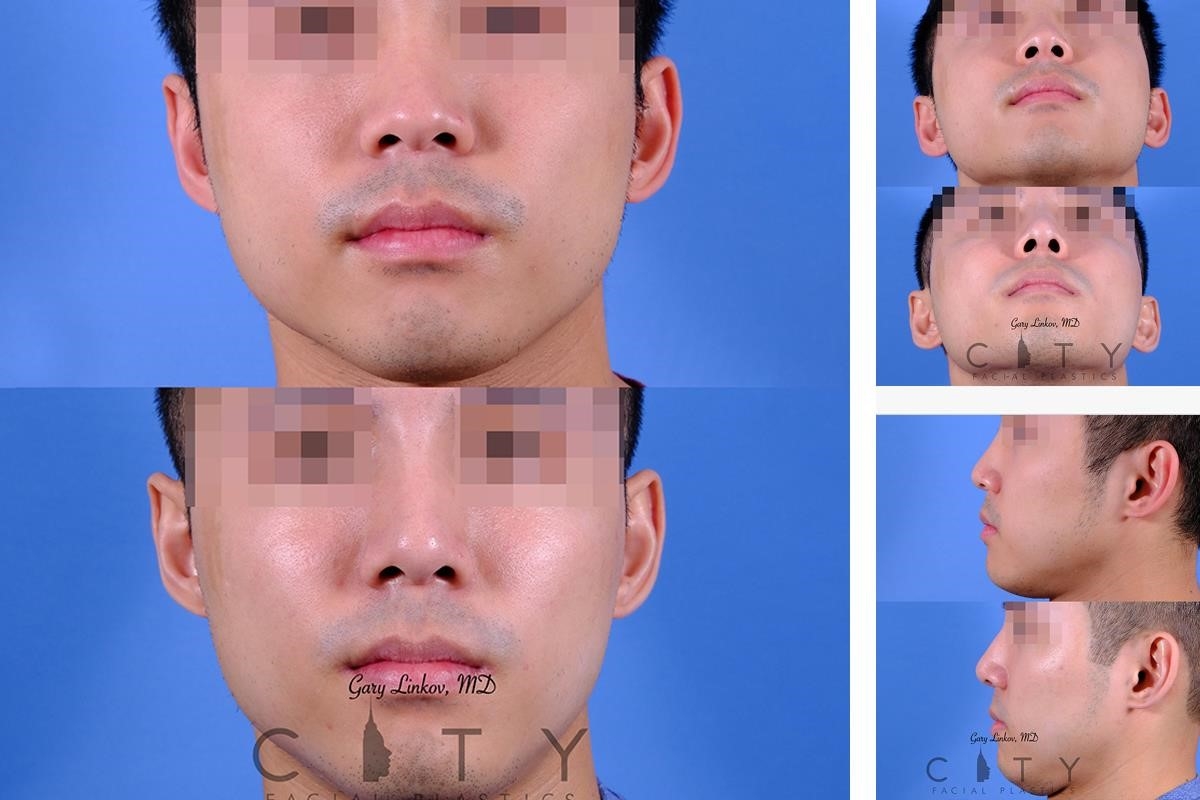 how much is rhinoplasty surgery